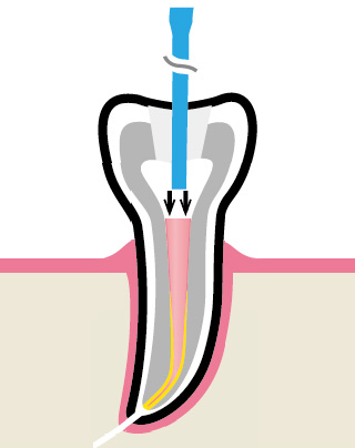 Вертикальная конденсация - уплотнение мастер-штифта